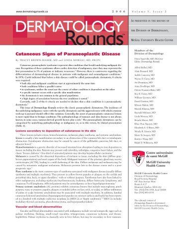 Cutaneous Signs of Paraneoplastic Disease - Dermatology Rounds ...