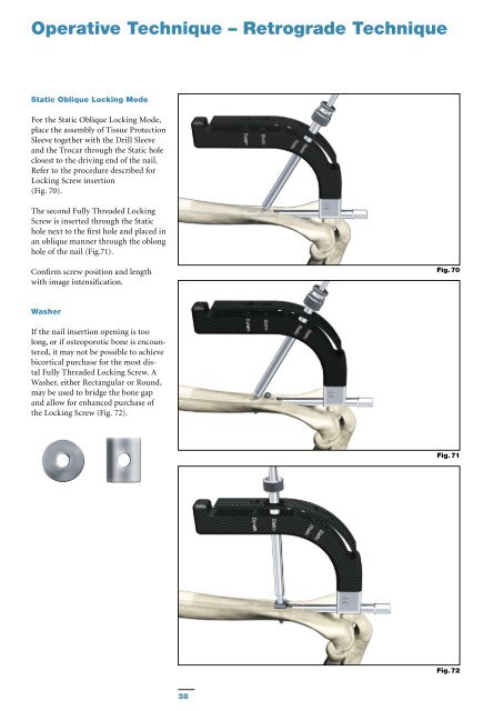 T2 Humeral Nailing System Operative Technique - Stryker