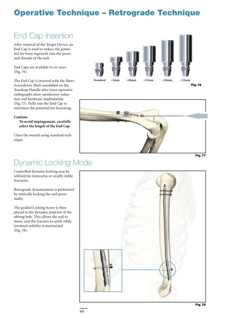 T2 Humeral Nailing System Operative Technique - Stryker