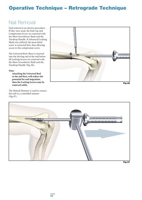 T2 Humeral Nailing System Operative Technique - Stryker