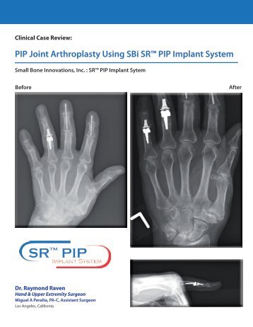 PIP Joint Arthroplasty Using SBi SR™ PIP Implant System
