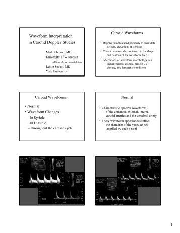 Waveform Interpretation in Carotid Doppler Studies