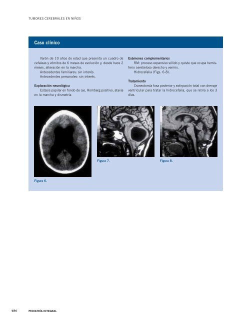 Tumores cerebrales en niños - Pediatría Integral