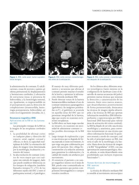 Tumores cerebrales en niños - Pediatría Integral