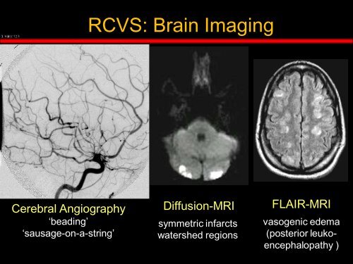 Reversible Cerebral Vasoconstriction Syndromes (RCVS)