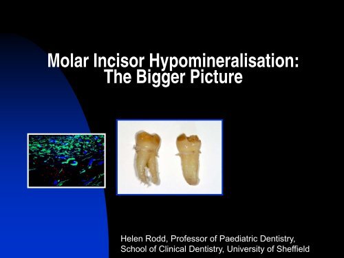 Molar Incisor Hypomineralisation: The Bigger Picture