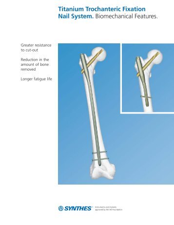 Titanium Trochanteric Fixation Nail System (PDF) - Synthes