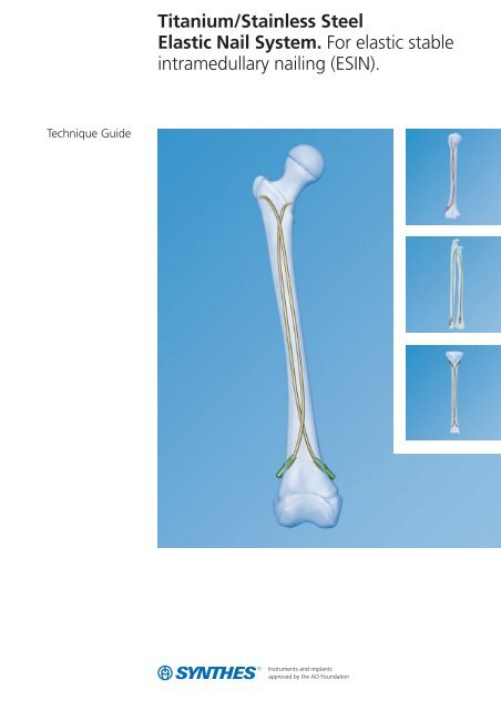 Suprapatellar Instrumentation for Titanium Cannulated Tibial Nails