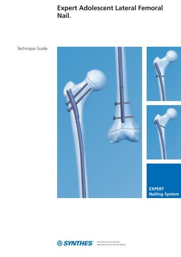 Expert R/AFN. Clavo femoral retrógrado /anterógrado. - Synthes