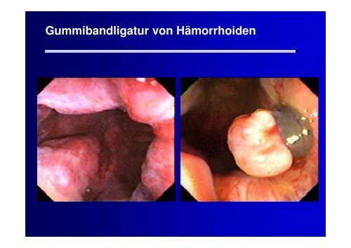 Vortrag Hämorrhoiden - Gastroenterologie Wettingen