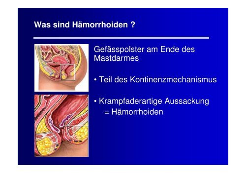 Vortrag Hämorrhoiden - Gastroenterologie Wettingen