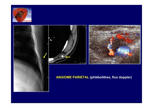 PAROI THORACIQUE J GIRON - Club Thorax