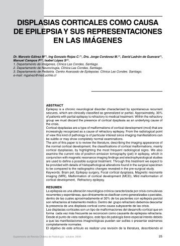 displasias corticales como causa de epilepsia y sus ... - SciELO