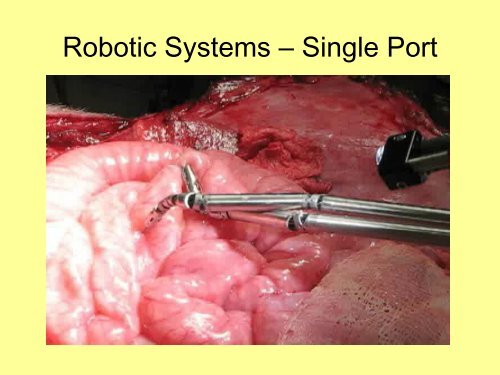 Chirurgie Gynécologique Coelioscopique Assistée par le robot ...