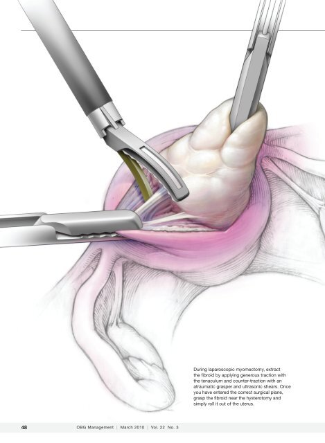 Laparoscopic Myomectomy - Brigham and Women's Hospital