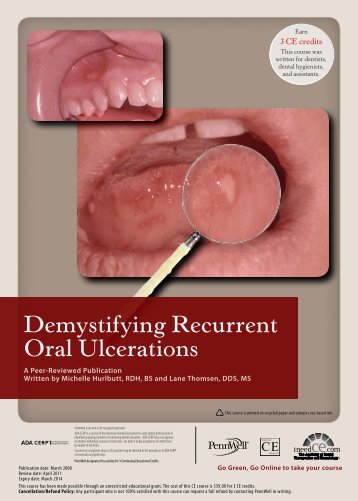 Demystifying Recurrent Oral Ulcerations - IneedCE.com