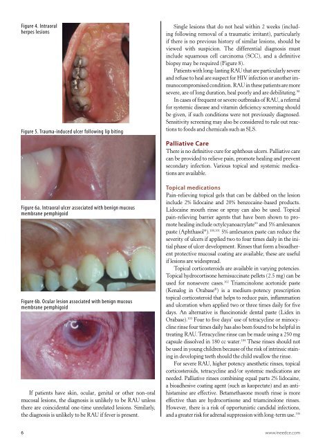 Demystifying Recurrent Oral Ulcerations - IneedCE.com