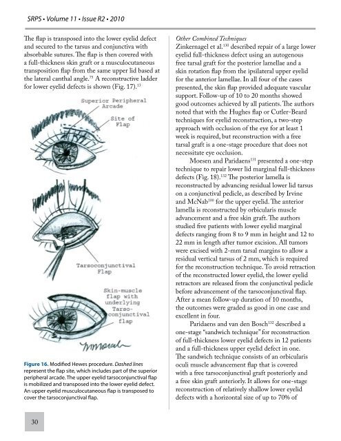 Vol 11-R2- Eyelid