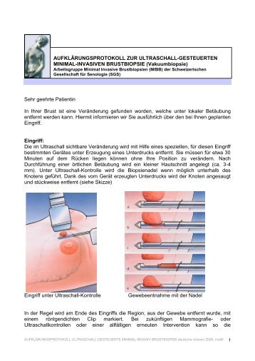 Aufklärungsblatt Vakuumbiopsie Ultraschall