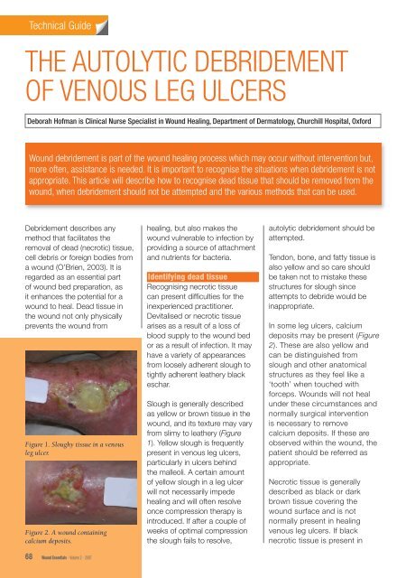 the autolytic debridement of venous leg ulcers - Wounds International