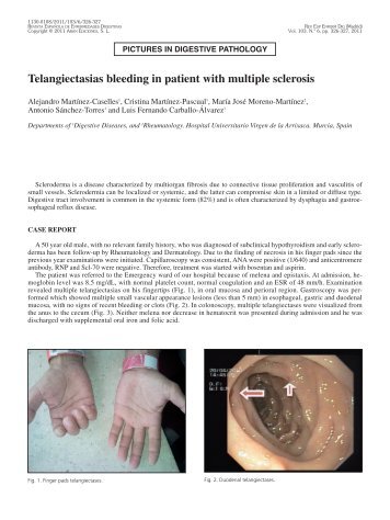 Telangiectasias bleeding in patient with multiple sclerosis