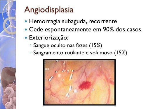 Hemorragias Digestivas