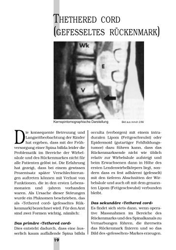Thethered cord (gefesseltes Rückenmark).pdf