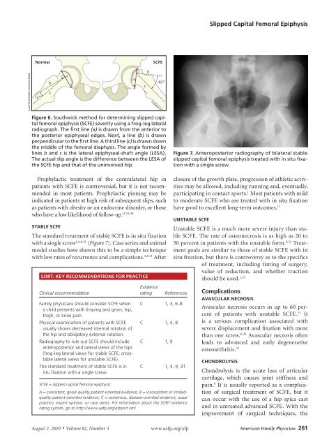 Slipped Capital Femoral Epiphysis: Diagnosis and Management