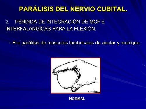 parálisis del nervio cubital.