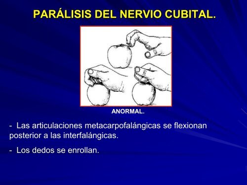 parálisis del nervio cubital.