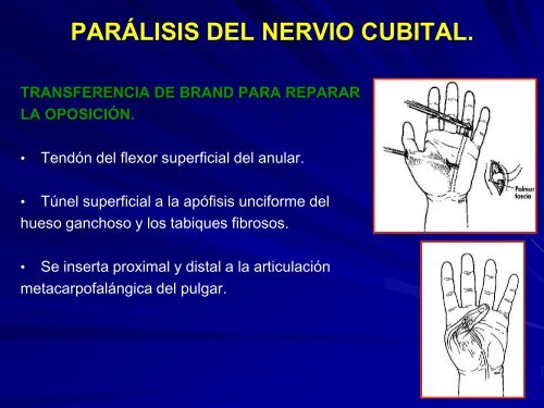 parálisis del nervio cubital.