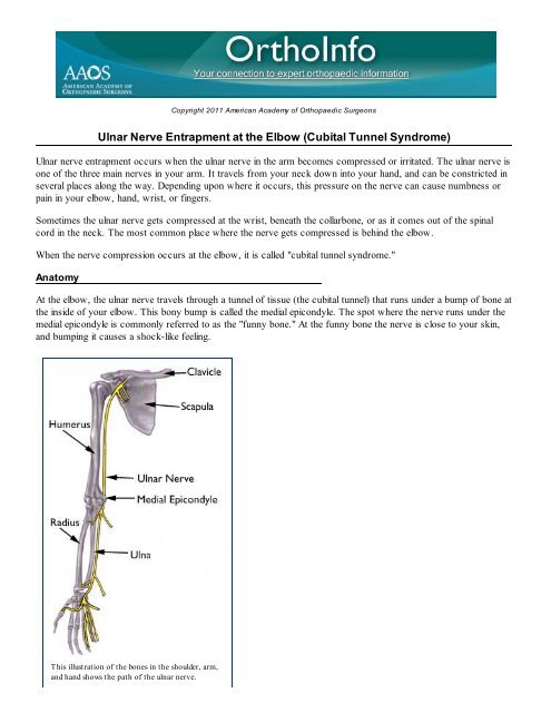 Ulnar Nerve Entrapment at the Elbow (Cubital Tunnel Syndrome