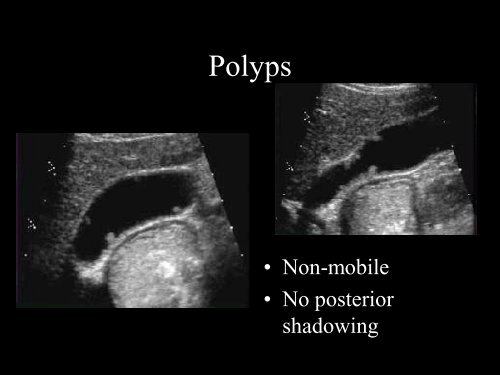 Abdominal Ultrasound - Livingston and Brighton ED