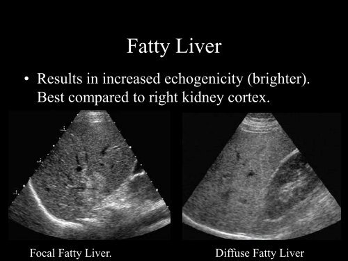 Abdominal Ultrasound - Livingston and Brighton ED