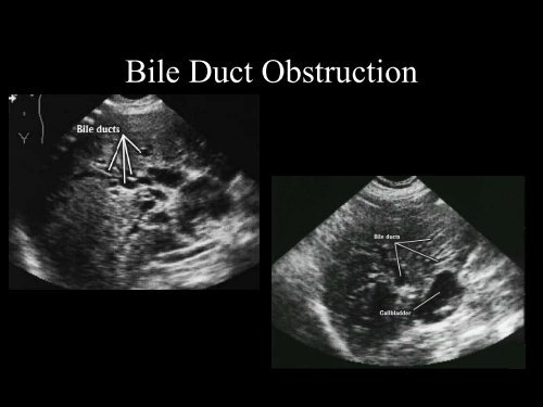 Abdominal Ultrasound - Livingston and Brighton ED