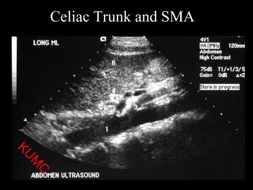 Abdominal Ultrasound - Livingston and Brighton ED