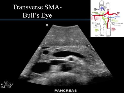 Abdominal Ultrasound - Livingston and Brighton ED