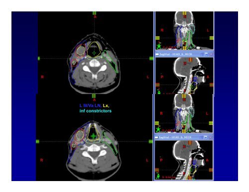 Basics of Head and Neck IMRT Planning and Anatomy - ASTRO