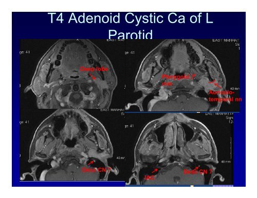 Basics of Head and Neck IMRT Planning and Anatomy - ASTRO