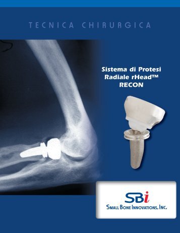 Tecnica Chirurgica rHead™ RECON - Small Bone Innovations