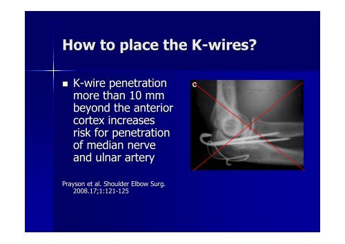 Olecranon fracture