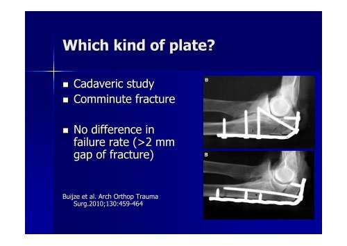 Olecranon fracture