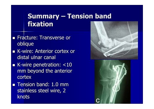 Olecranon fracture