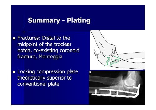 Olecranon fracture