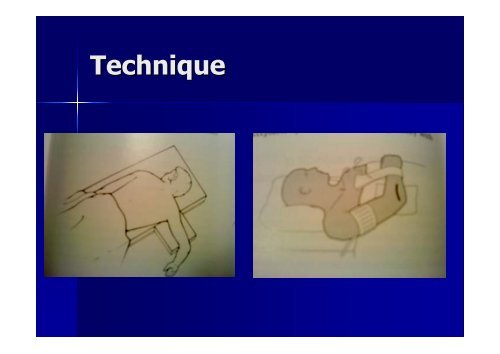 Olecranon fracture