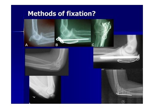 Olecranon fracture