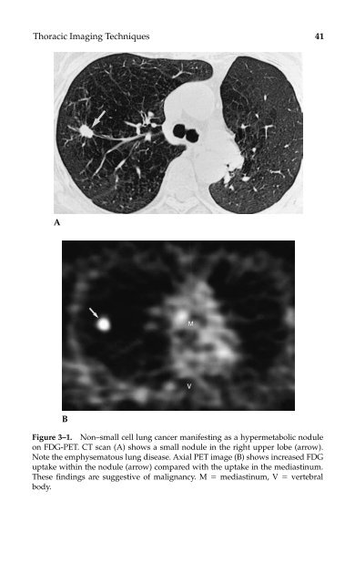 Lung Cancer.pdf