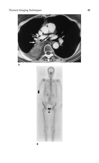 Lung Cancer.pdf