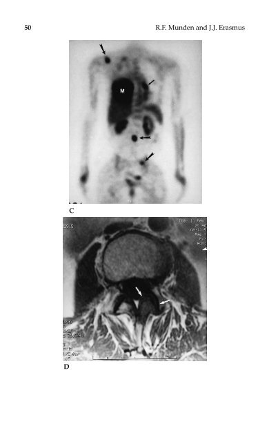 Lung Cancer.pdf