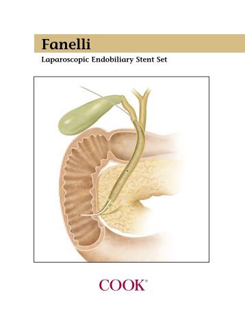 Fanelli Laparoscopic Endobiliary Stent Set - Cook Medical